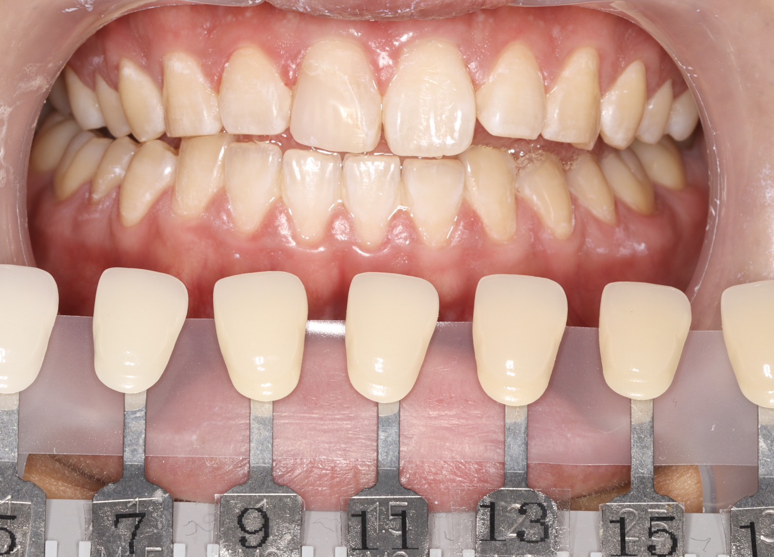 トランセントフラッシュホワイトニング1回照射(10分）の症例（治療後）