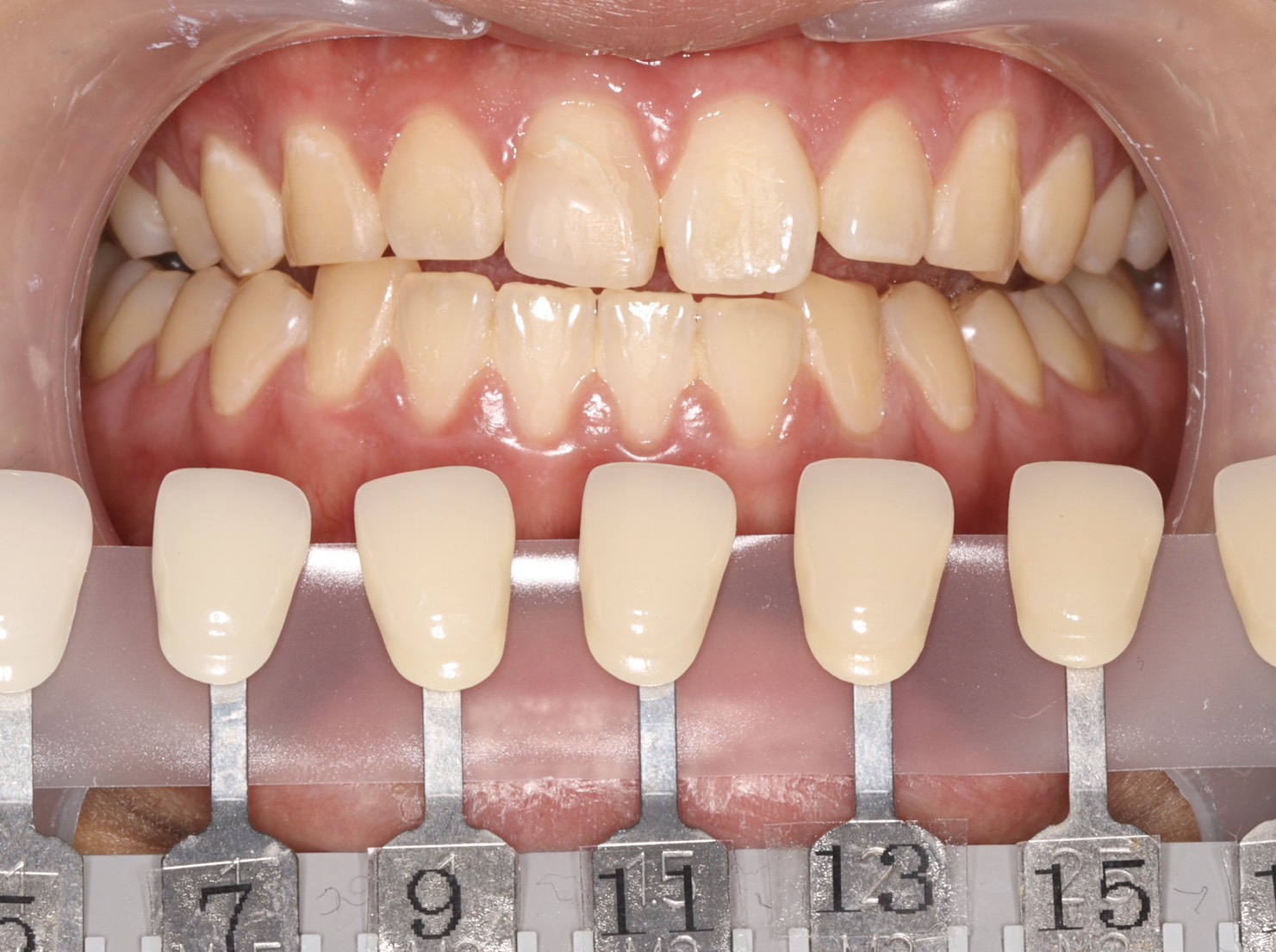 トランセントフラッシュホワイトニング1回照射(10分）の症例（治療前）