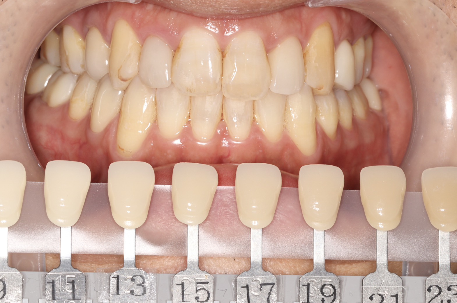 トランセントフラッシュホワイトニング1回照射(10分）の症例（治療前）