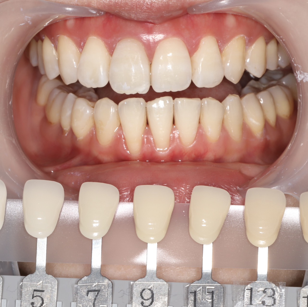 トランセントフラッシュホワイトニング1回照射(10分）の症例（治療後）