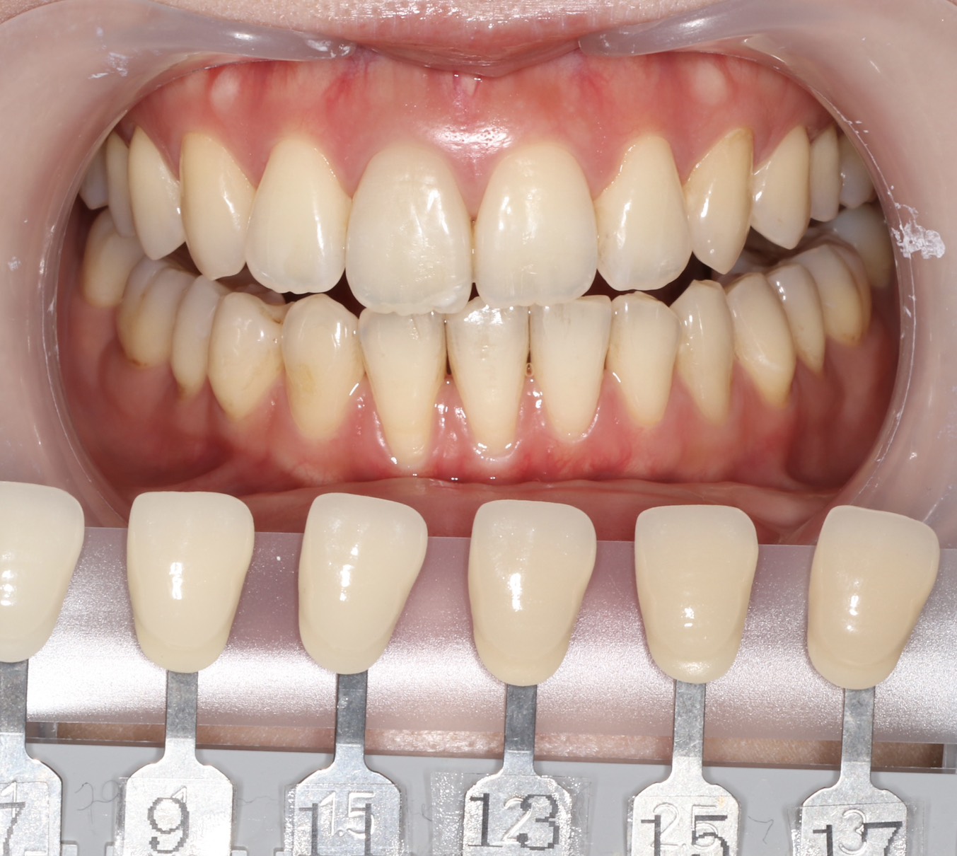トランセントフラッシュホワイトニング1回照射(10分）の症例（治療前）