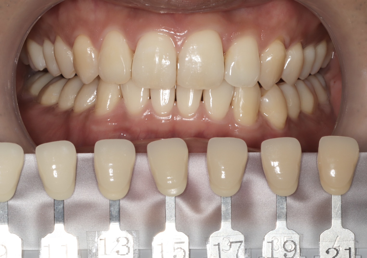 トランセントフラッシュホワイトニング1回照射(10分）の症例（治療前）