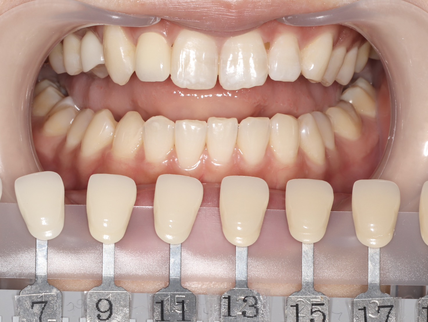 トランセントフラッシュホワイトニング1回照射(10分）の症例（治療前）