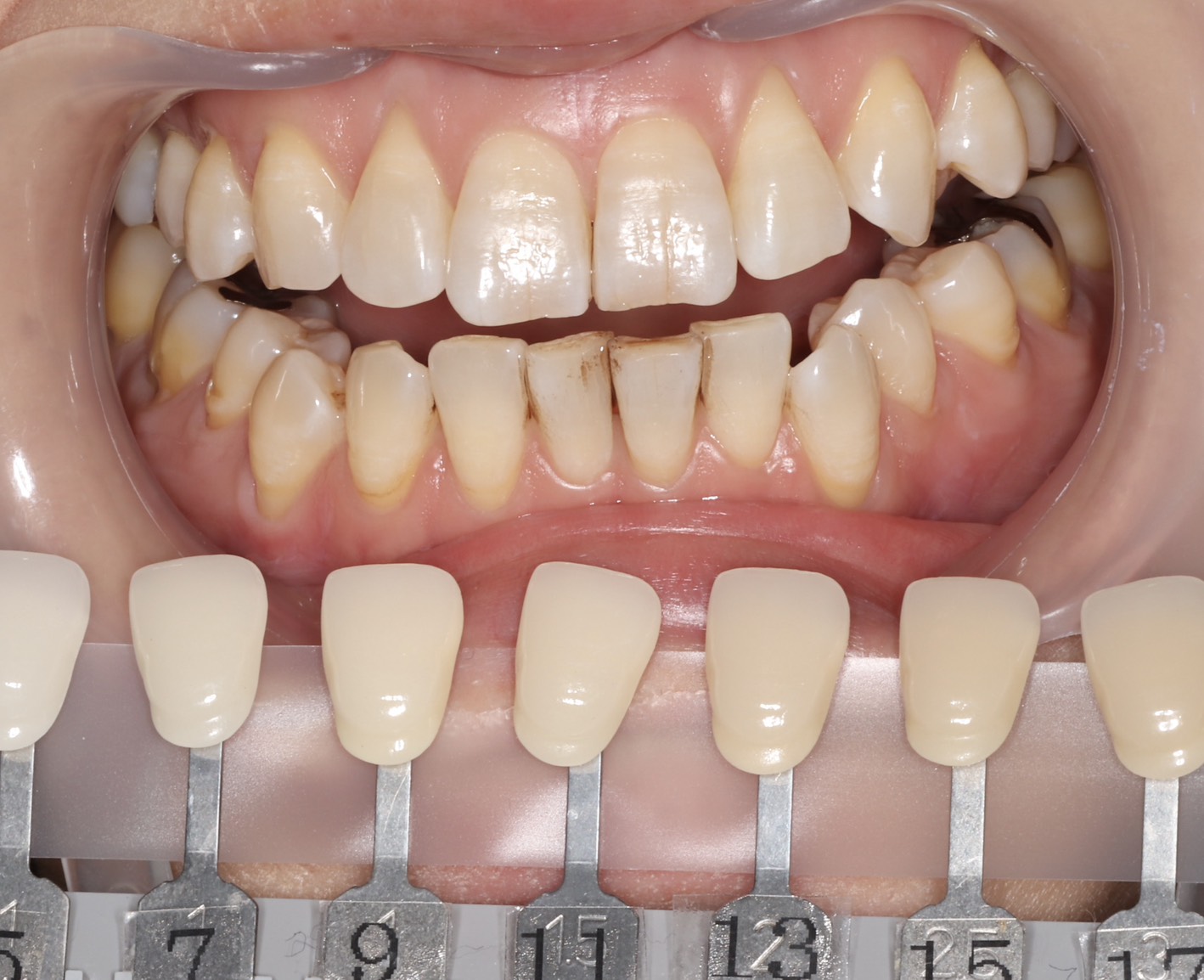 トランセントフラッシュホワイトニング1回照射(10分）の症例（治療前）