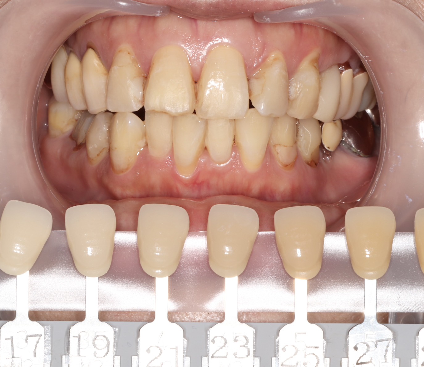 トランセントフラッシュホワイトニング1回照射(10分）の症例（治療前）