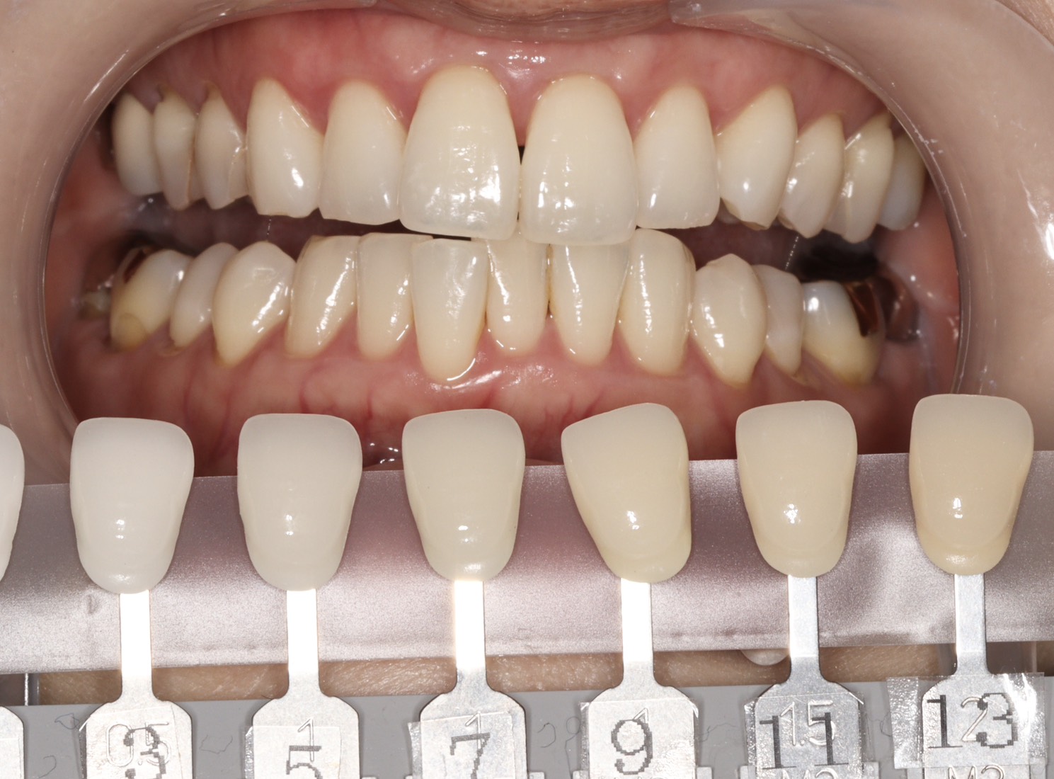 トランセントフラッシュホワイトニング1回照射(10分）の症例（治療前）