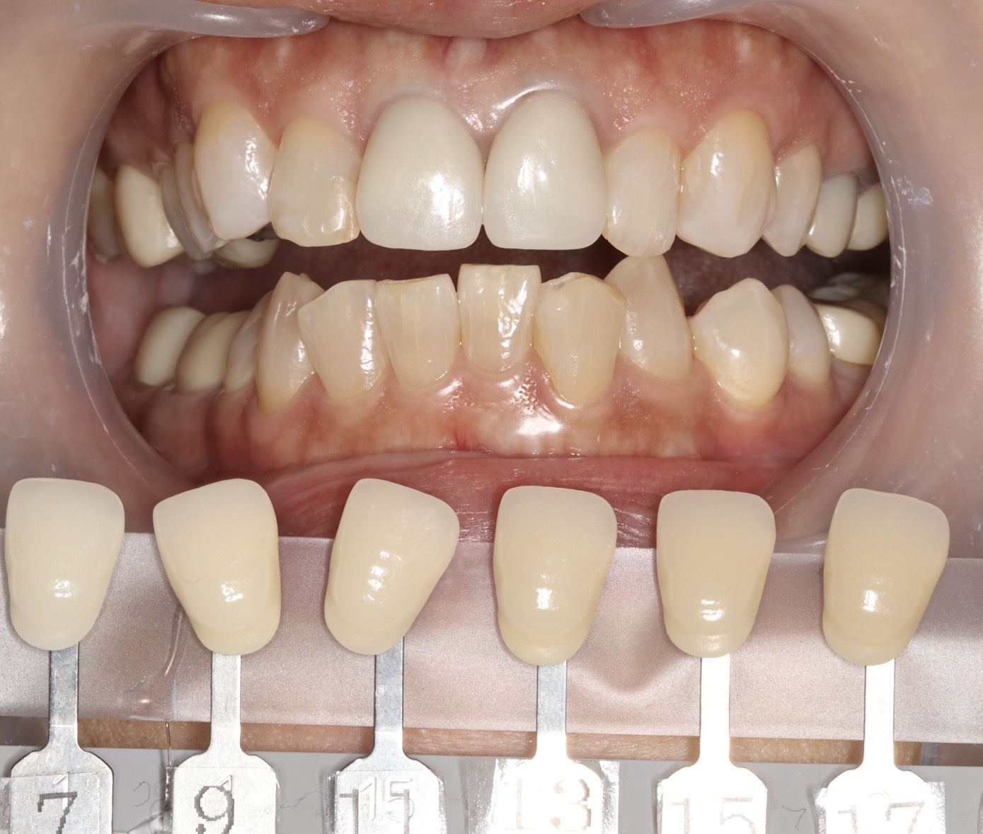 トランセントフラッシュホワイトニング1回照射(10分）の症例（治療前）