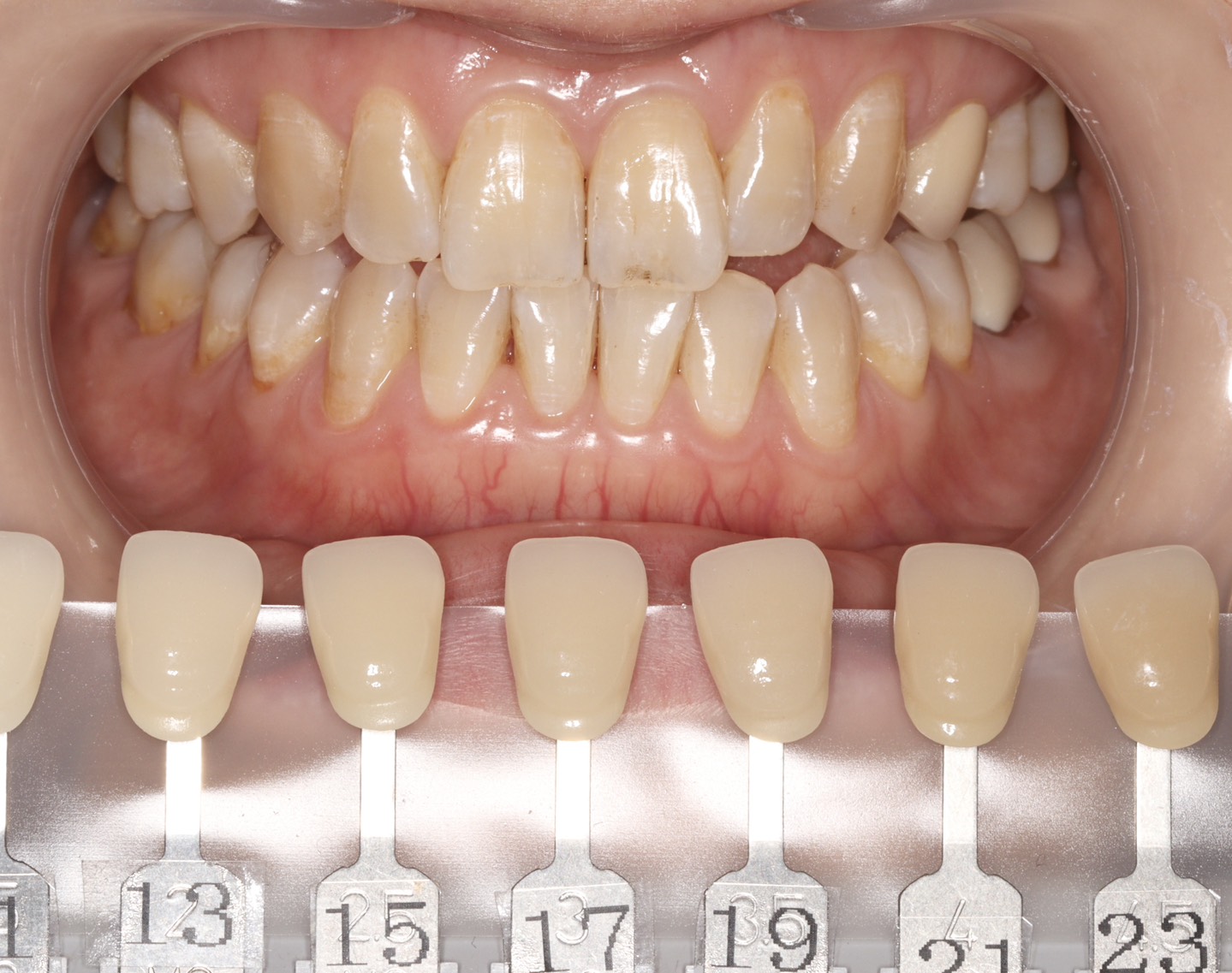 トランセントフラッシュホワイトニング1回照射(10分）の症例（治療前）