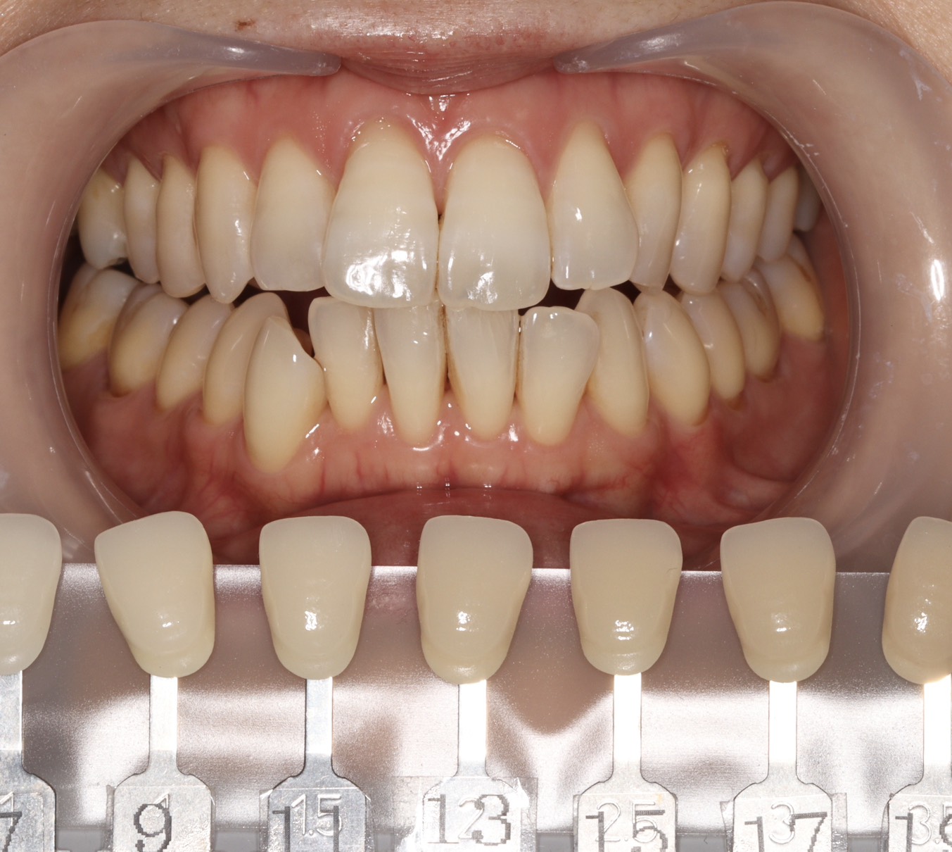 トランセントフラッシュホワイトニング1回照射(10分）の症例（治療前）