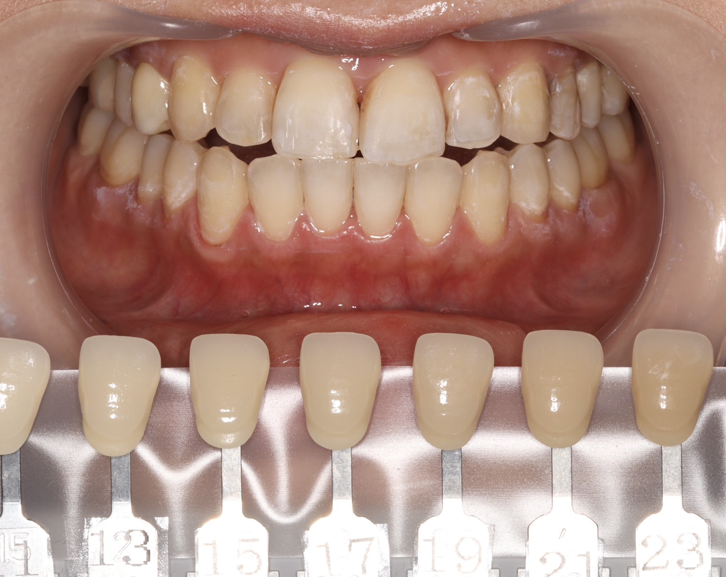 トランセントフラッシュホワイトニング1回照射(10分）の症例（治療後）