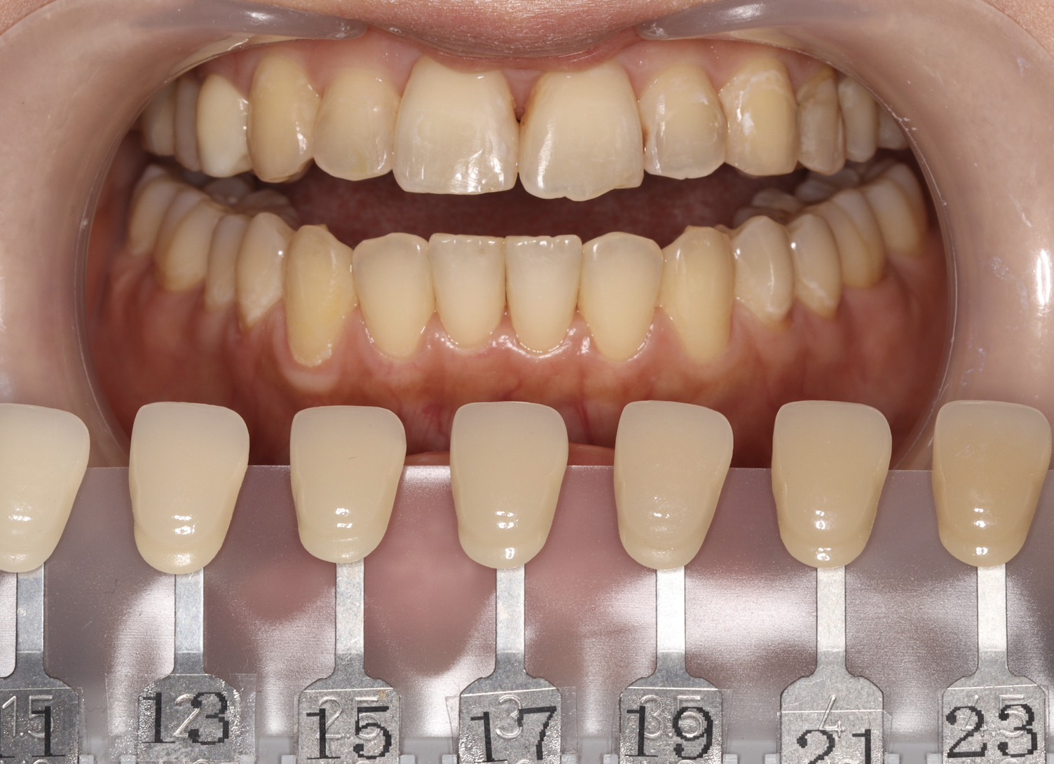 トランセントフラッシュホワイトニング1回照射(10分）の症例（治療前）