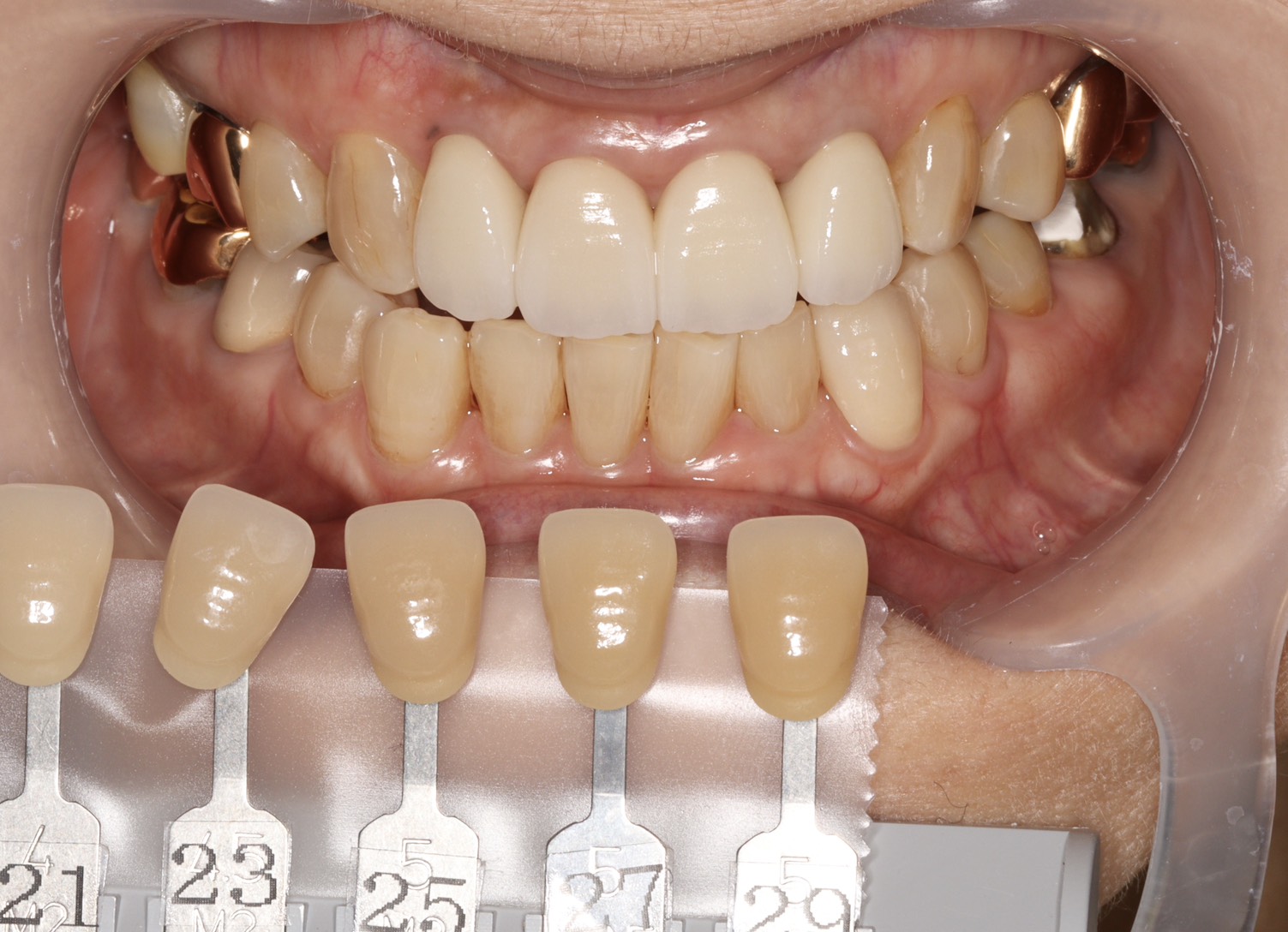 トランセントフラッシュホワイトニング1回照射(10分）の症例（治療前）
