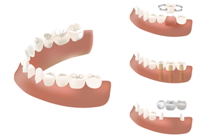 失った歯の本数・場所によって異なる治療方法