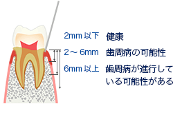 OHIS　歯周病リスク検査