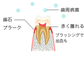 歯周病治療